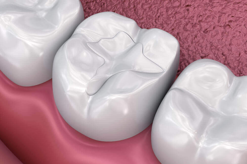 Composite Tooth Colored Fillings • Northwoods Dental Spa