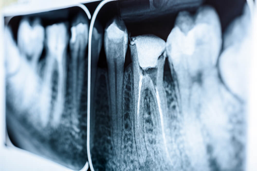 Root Canals • Northwoods Dental Spa